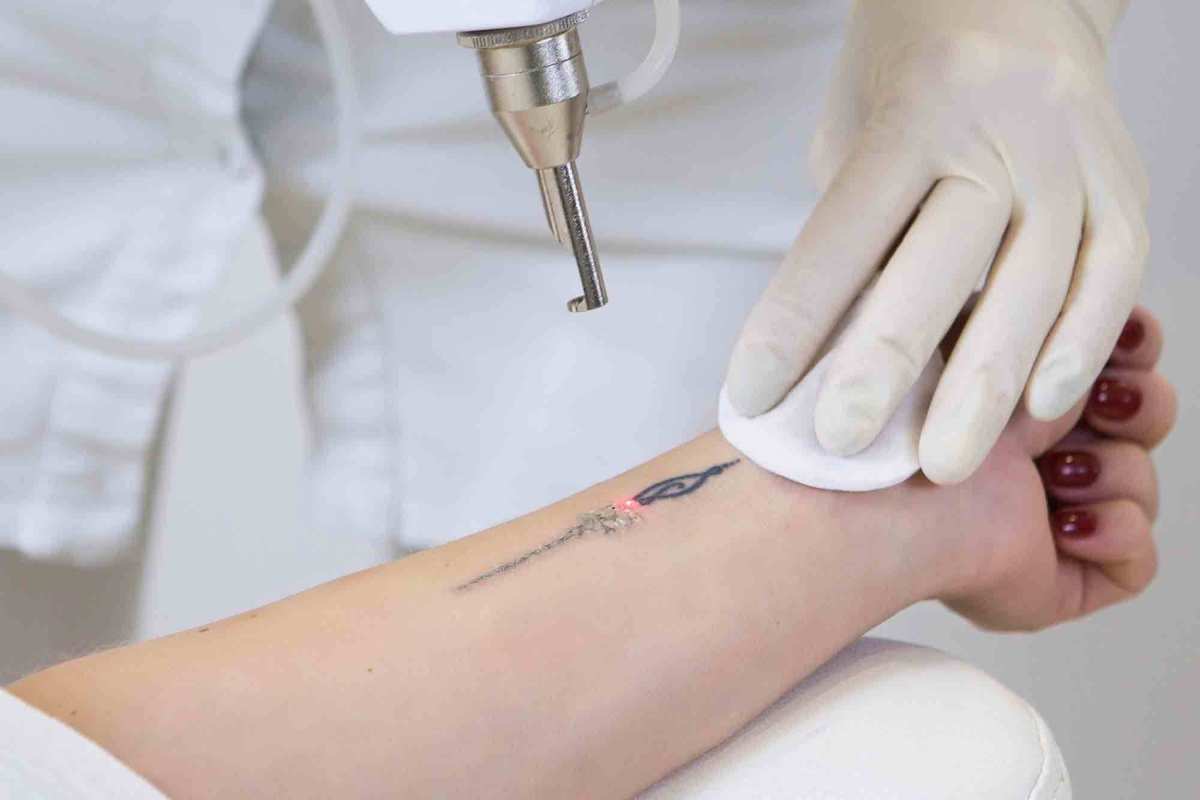 Why-Laser-Tattoo-Removal