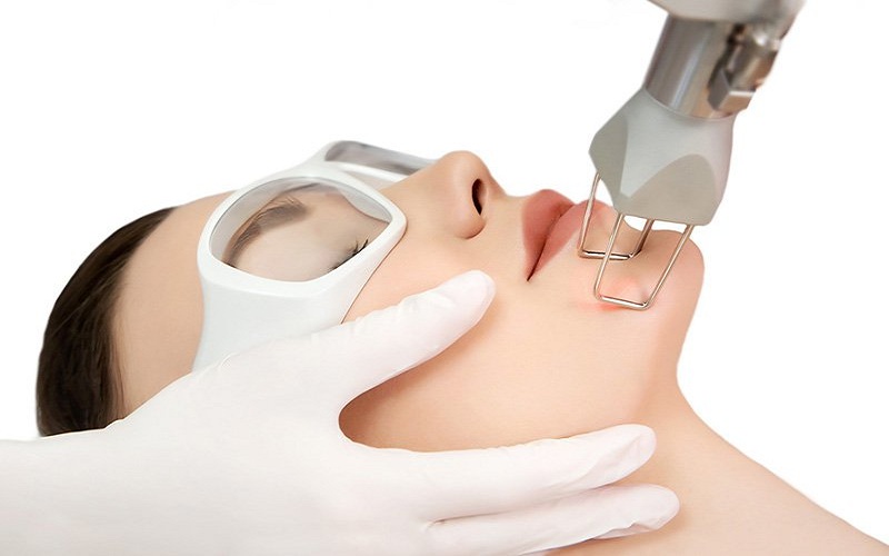 Công nghệ trị sẹo Laser CO2 Fractional