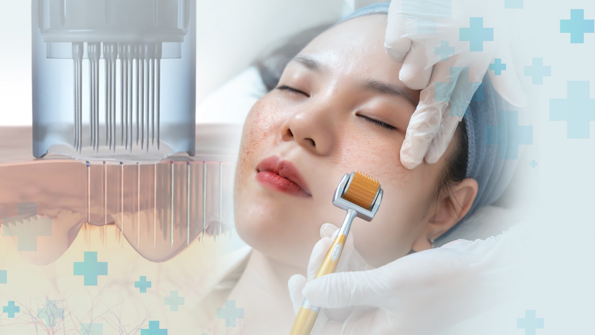 công nghệ trị sẹo rỗ hiệu quả bằng vi kim