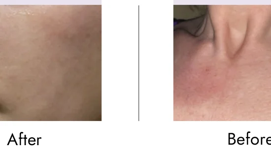 Hình ảnh trước và sau của EVEHILO