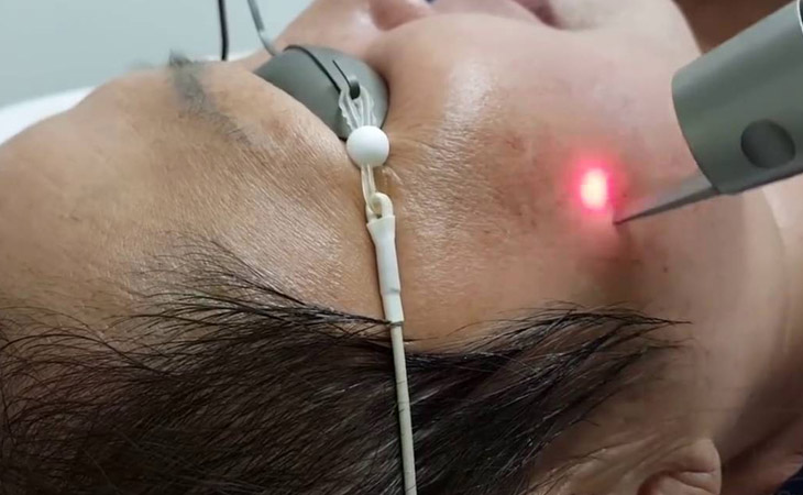 An-toan-laser-tri-nam
